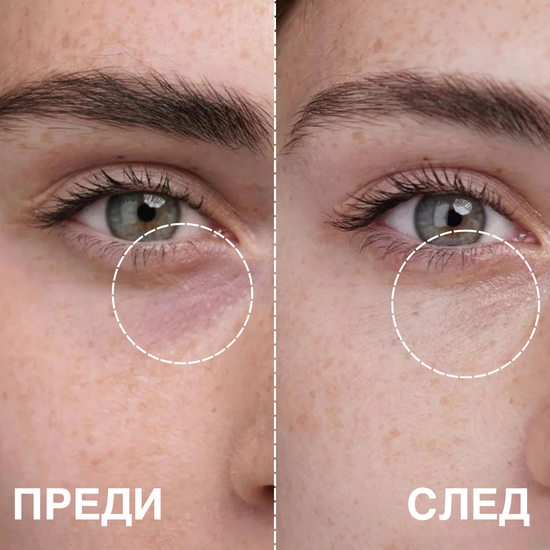 GLOW™ - Microneedle patches (Пачове за очи с микроигли)